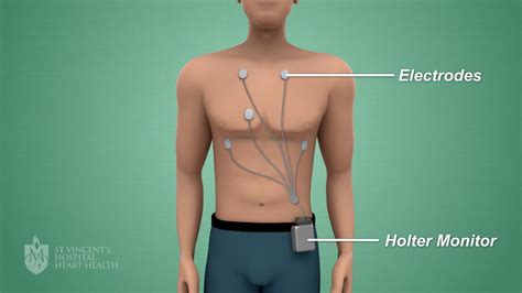 Holter Monitor - St Vincent's Heart Health