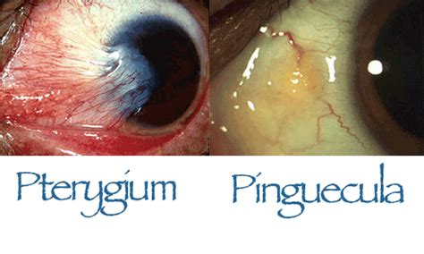 All About The World: PINGUEKULA, PTERIGIUM DAN PSEUDO-PTERIGIUM