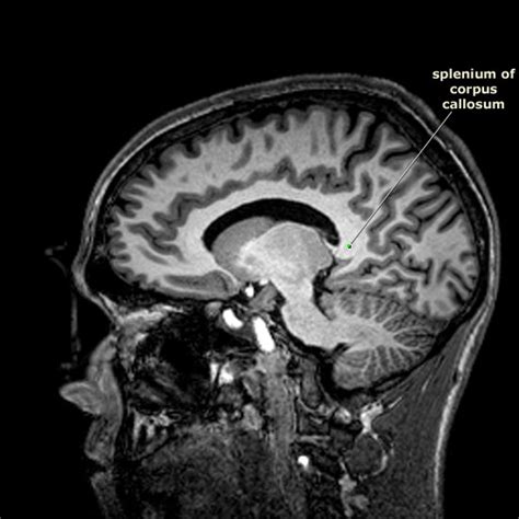 Index of /Neuro/Radiology/rad_sagittal_T1/5