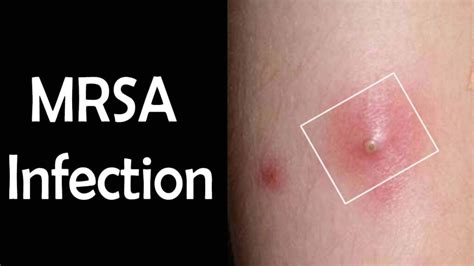 MRSA Infection - Symptoms, Causes and Methods to Cure MRSA Infection