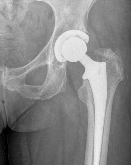 Hip Dysplasia Surgery & Treatment | VBJS