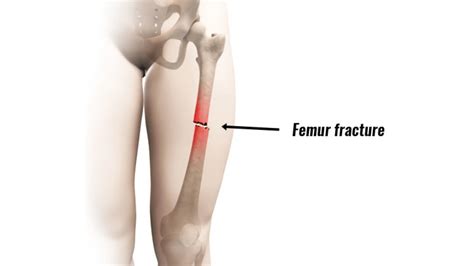 Fracture in Femur: Types, Causes, Symptoms & Treatments | Credihealth