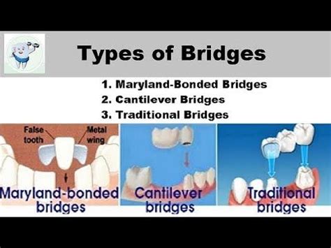 Types Of Dental Bridges - YouTube | Dental bridge, Dental bridge cost, Dental