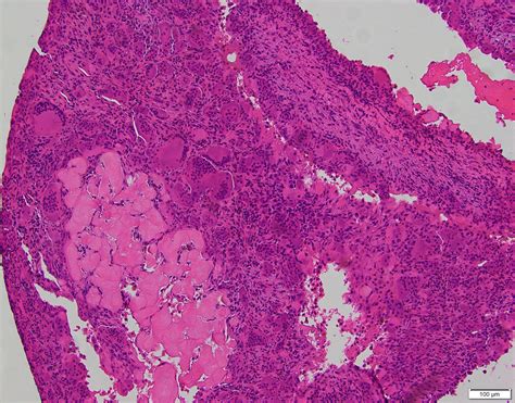 Aneurysmal Bone Cyst Jaw Histology