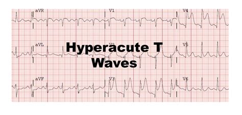 Peaked T Waves