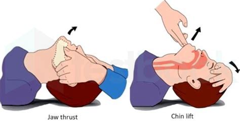 [Solved] Airway maneuver to open airway recommended in trauma patient