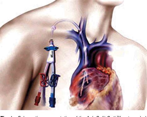 Placement, Performance and Complications of the Ash Split Cath™ Hemodialysis Catheter | Semantic ...