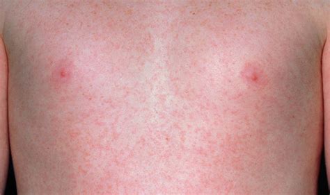 Measles: Symptoms, vaccine and the best treatment for the rash | Express.co.uk