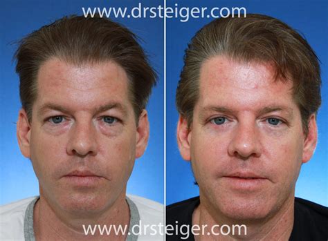 blepharoplasty-before-and-after