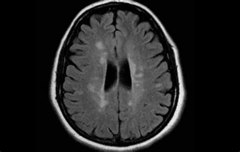 Ms Brain Mri With Contrast