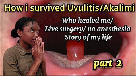 I had a live surgery 😱😥| Uvulitis | part 2 | story of my life 📝📖 - YouTube