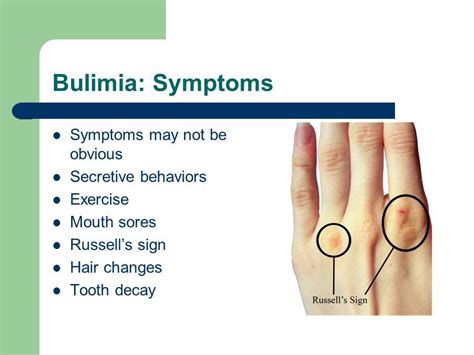 Russells Sign Bulimia