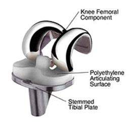 Knee Replacement Surgery: Procedure, Types and Risks | HSS