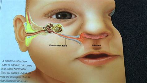 Pediatric Ear Infections - YouTube