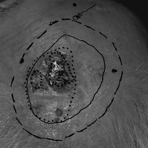 Sclerosing squamous cell carcinoma of forehead Visualized under white ...