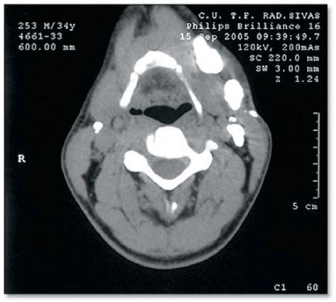 Several calcified lymph nodes are seen in the CT image. | Download ...