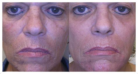 Micro Laser Peel | Dermatology Realm | Skin Care Memphis