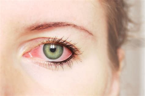 Pink Eye Causes and Treatment