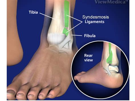 Image Gallery syndesmosis ankle