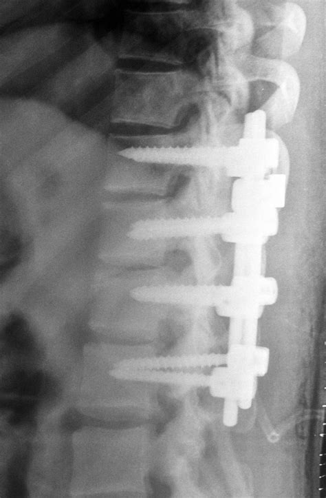 Transverse Process Fracture Orthobullets : Thoracolumbar Burst Fractures Spine Orthobullets, The ...