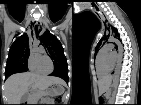 Hamman’s crunch: a forgotten clue to the diagnosis of spontaneous pneumomediastinum | BMJ Case ...