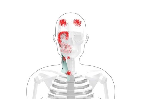 Sternocleidomastoid Trigger Points (Overview and Self Treatment)