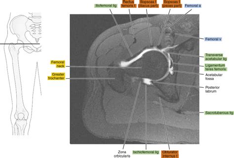 MR arthrography of the hip | Radiology Key