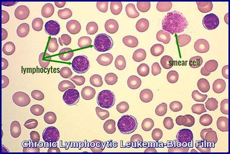 Chronic Lymphocytic Leukemia - Ask Hematologist | Understand Hematology