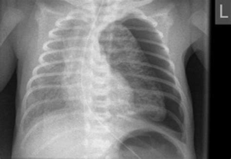 Infant Pneumothorax X Ray