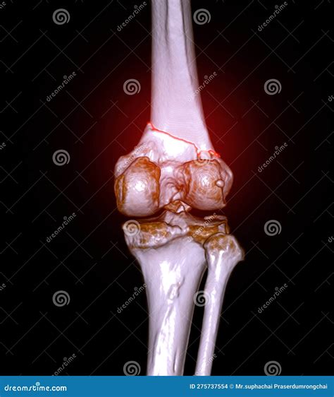 CT Scan Of Knee Joint Showing Fracture Of Distal Femur Bone Stock Image | CartoonDealer.com ...