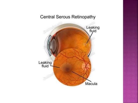 central serous chorioretinopathy