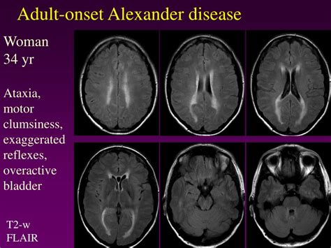 PPT - Radiological aspects of genetic disorders with adult-onset CNS symptoms PowerPoint ...