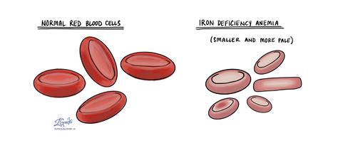 Iron Deficiency Anemia Red Blood Cells