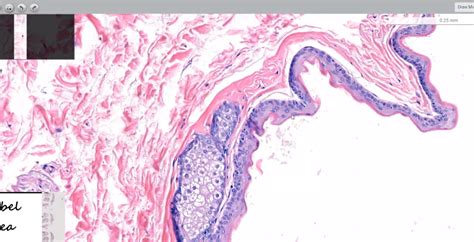 Identifying the Distinct Characteristics of Steatocystoma | PathologyWatch