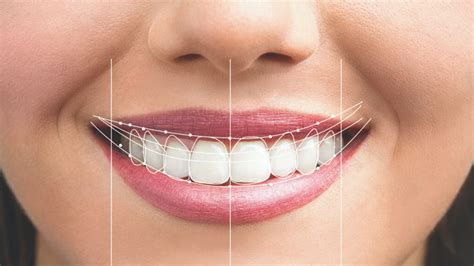 What is Digital Smile Design (DSD) | North Sydney Dental Practice