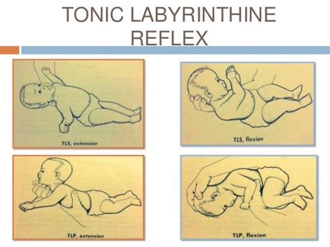 tonic labyrinthine reflex TLS: tonic labyrinthine supine TLP: tonic labyrinthine prone Nbcot ...