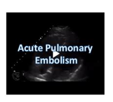 McConnell' Sign: Pulmonary Embolism - Sumer's Radiology Blog