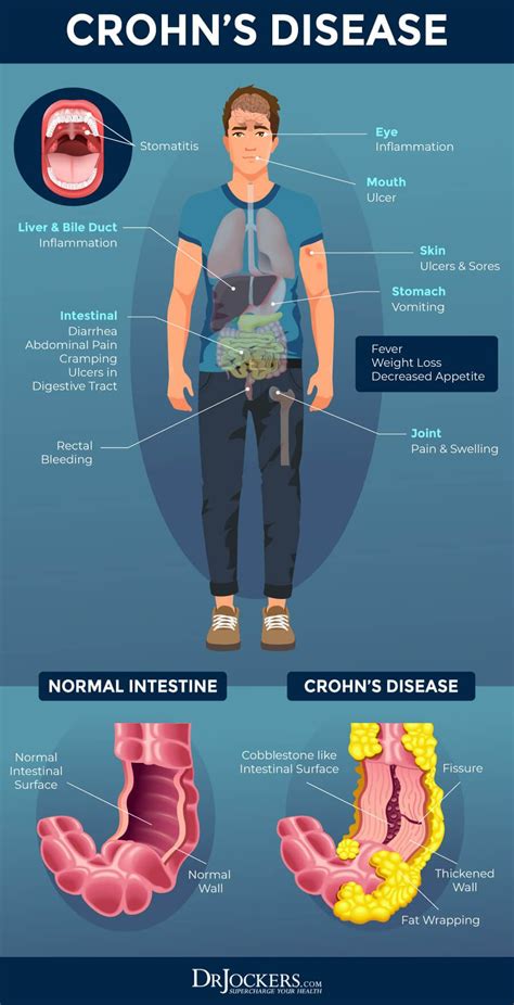 Disease symptoms – Artofit