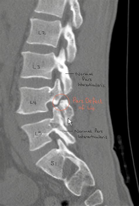 Pars Defect - Spines Dorset