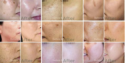 Treatment Singapore - Freckles,Melasma,Acne Marks,Age Spots