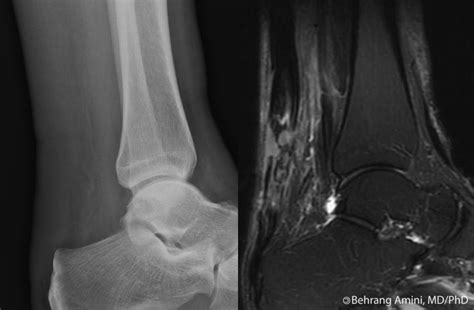 Roentgen Ray Reader: Achilles Tendon Rupture: Radiography