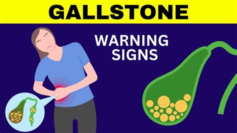 Gallbladder Stones Symptoms | Cholelithiasis | Gallstones Symptoms | Gallstones Warning Signs ...