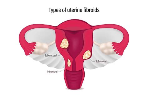 Types Of Uterine Fibroids Submucosal Subserosal And Intramural Fibroids ...