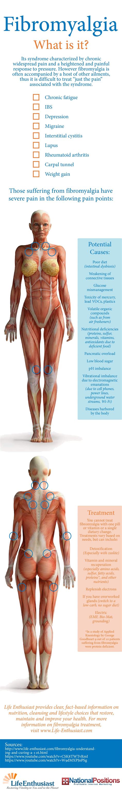 Fibromyalgia: What is it? Infographic | Fibromyalgia, What is fibromyalgia, Fibromyalgia ...