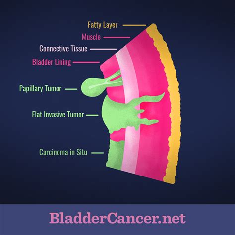 13+ Different Types Of Bladder Cancer UK - Betty G. Berger