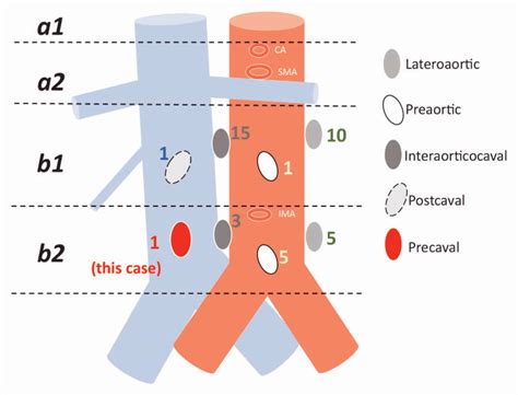 Anatomical location of paraaortic lymph nodes with metastasis based on ...