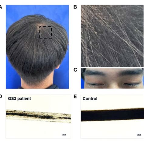 | Hair phenotypes of a patient with Griscelli syndrome type 3 (GS3).... | Download Scientific ...