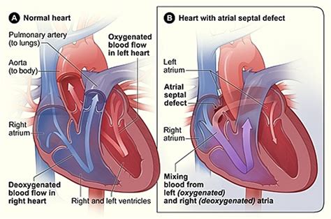 What is Congenital Heart Disease - Types, Causes, and Symptoms