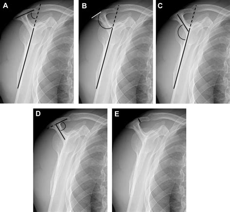 Acromial fractures following reverse shoulder arthroplasty: the role of ...