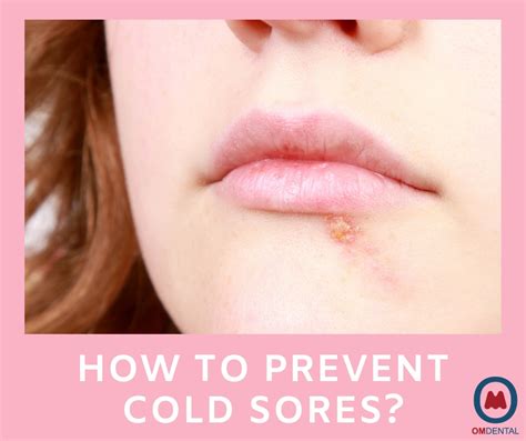 Stop Cold Sores- Get Rid Of Your Cold Sore Quickly